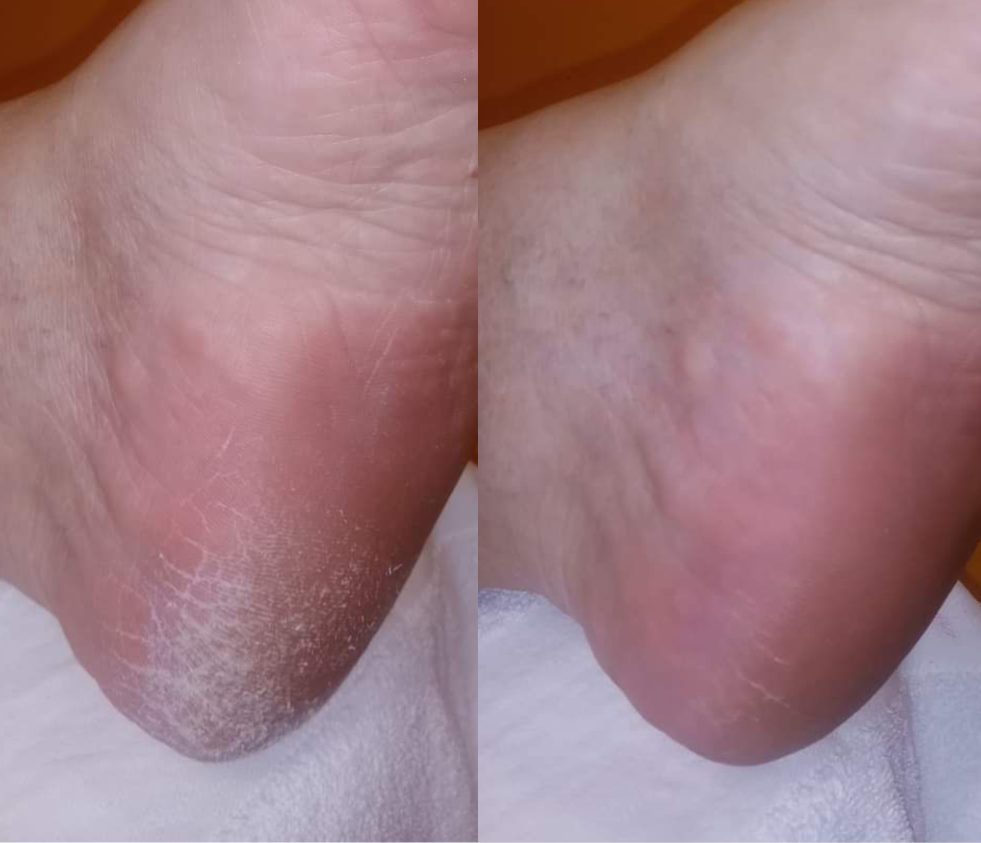 Spray Callos y Durezas 20% Urea FeetCalm 🦶 - Imagen 2