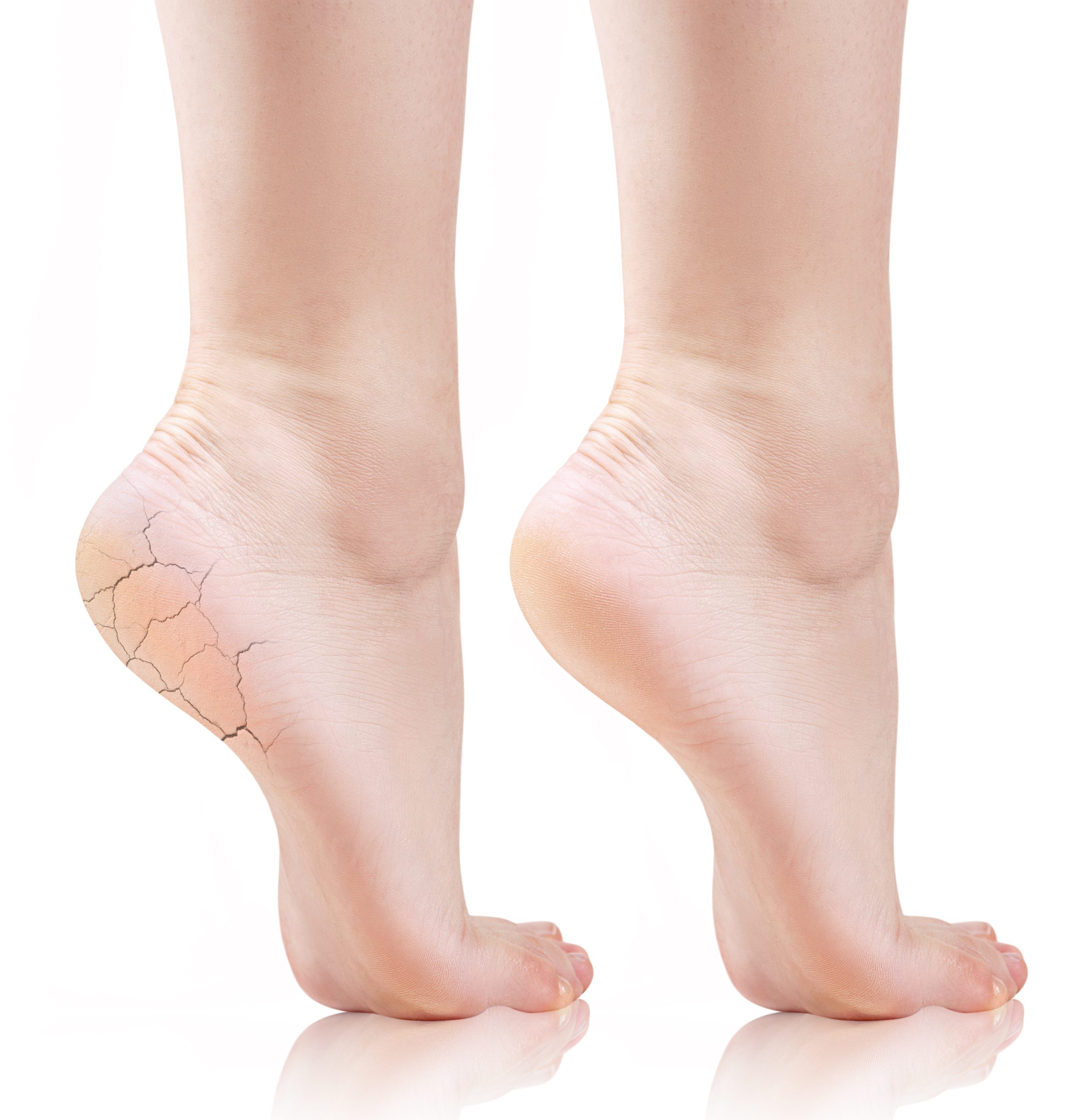 Mousse Talones Agrietados 25% Urea FeetCalm 🦶 - Imagen 4